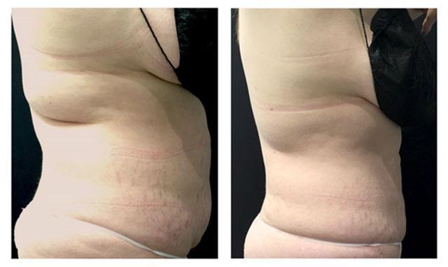 Cool sculpting results before after