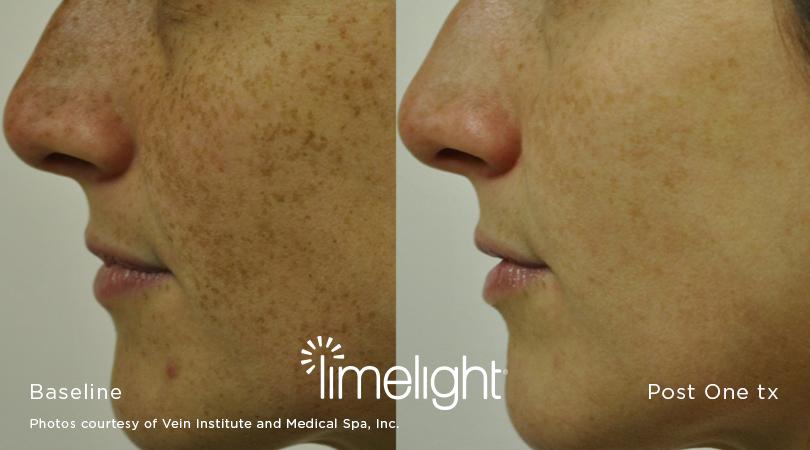 XEO limelight results before after