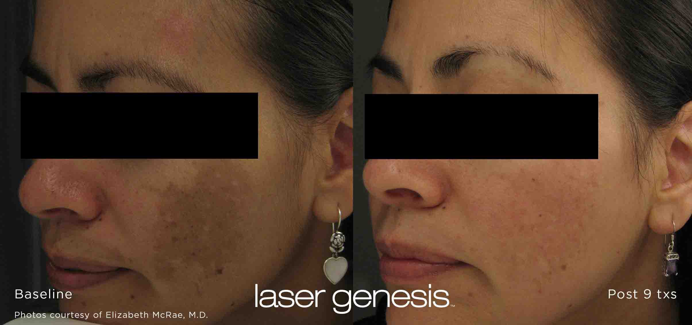 XEO laser genesis results before after
