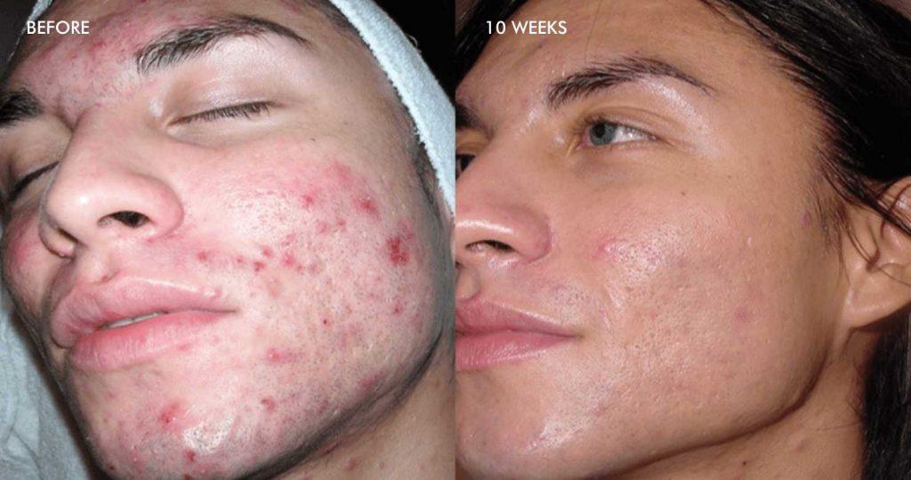 Acne results before after