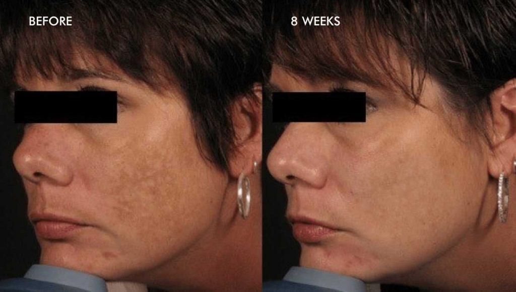 Melasma results before after