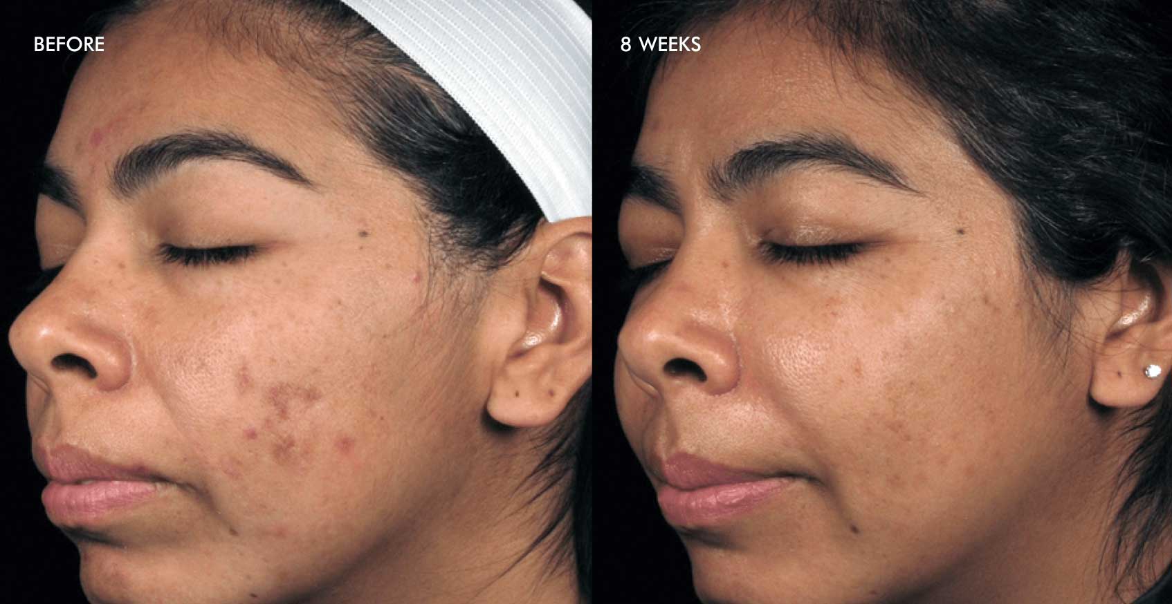 Pih results before after