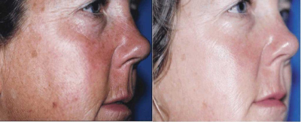 Vitamin C Hydrating results before after