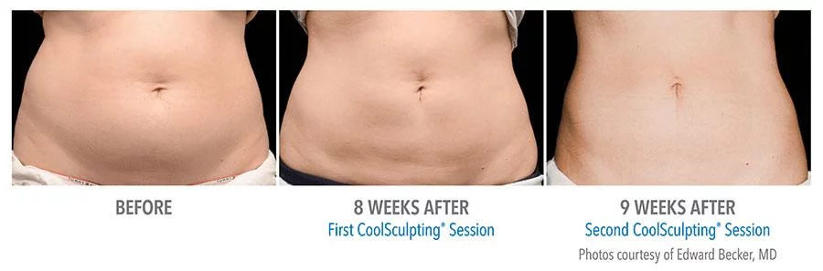 What is Coolsculpting and what are the benefits, normal body excretion, What is Coolsculpting, Blog, Skincare Blogs